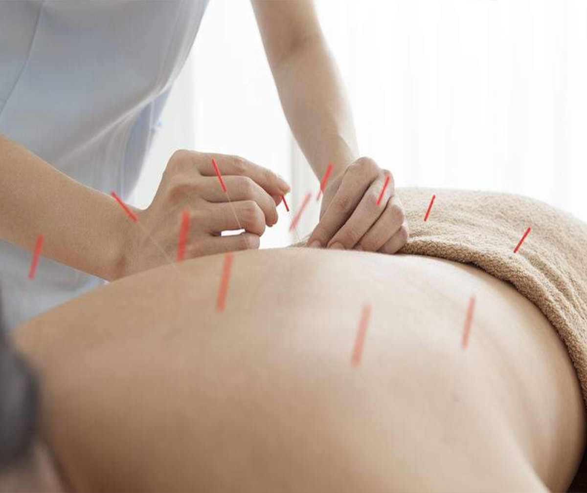 weight Loss acupuncture at igood health Centre in Richmond Hill
