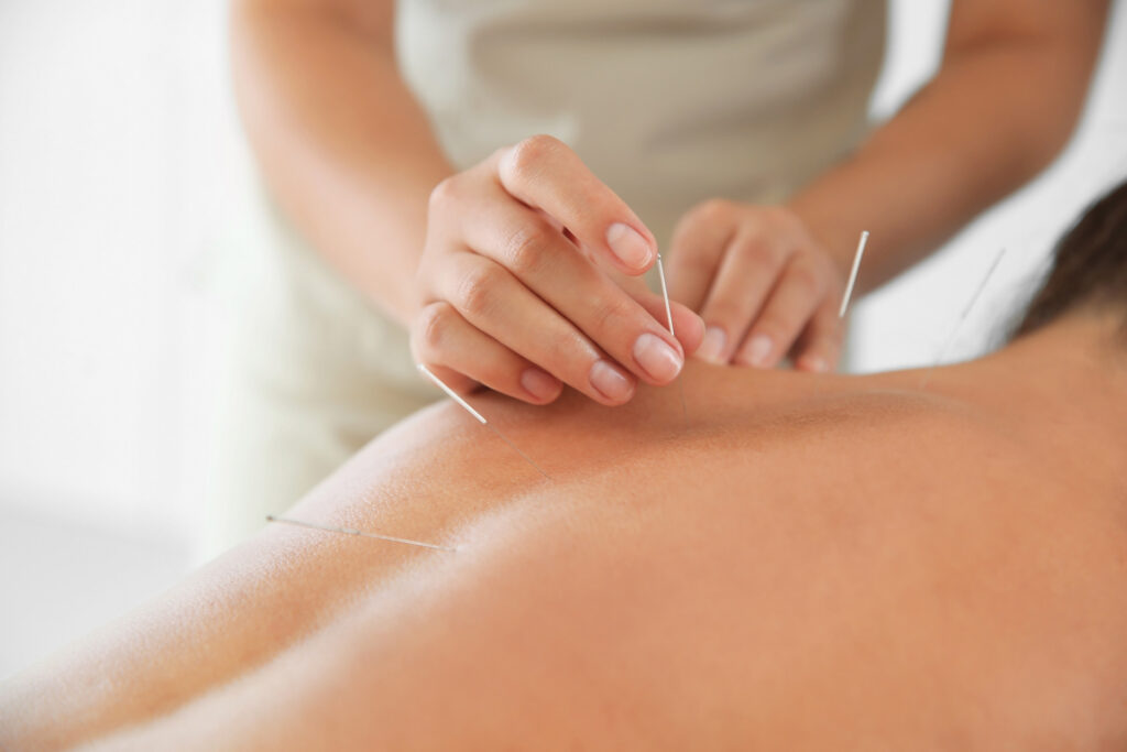 Acupuncture treatment being performed at iGood Health Centre in Richmond Hill.